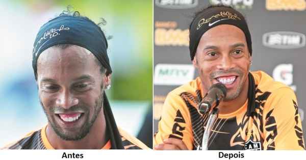 Jogador Ronaldinho Gacho antes e depois do tratamento dentrio: transformao total aps cirurgia de gengiva, colocao de faceta de porcelana e clareamento(foto: Rodrigo Clemente/EM)