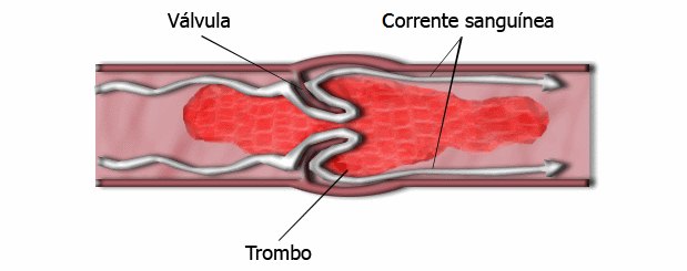 O trombo se forma porque o fluxo de sangue que desce ou sobe pode não conseguir voltar, fazendo com que o 'excesso' fique acumulado nas válvulas das veias(foto: Wikimedia/Reprodução) O trombo se forma porque o fluxo de sangue que desce ou sobe pode não conseguir voltar, fazendo com que o 'excesso' fique acumulado nas válvulas das veias(foto: Wikimedia/Reprodução)