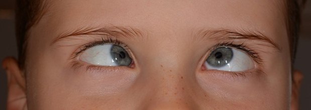 O estrabismo ocorre quando os músculos dos olhos deixam de agir em perfeito equilíbrio e sincronia(foto: Pixabay) O estrabismo ocorre quando os músculos dos olhos deixam de agir em perfeito equilíbrio e sincronia(foto: Pixabay)