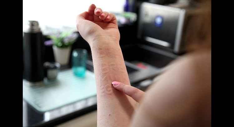 A dermatografia permite que a jovem inglesa A dermatografia permite que a jovem inglesa