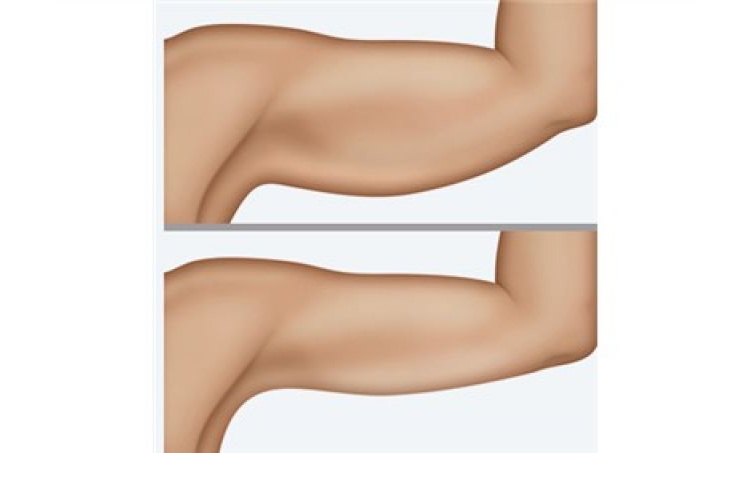 O lifting de braço, ou braquioplastia, é a retirada do excesso de pele, flácida, na parte de baixo do membro(foto: Ricardodetoni.com.br/Reprodução) O lifting de braço, ou braquioplastia, é a retirada do excesso de pele, flácida, na parte de baixo do membro(foto: Ricardodetoni.com.br/Reprodução)