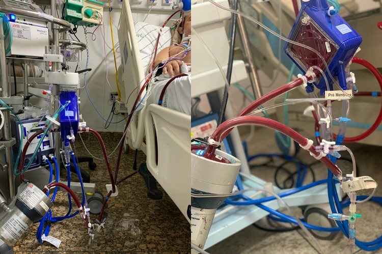 Saiba Mais Sobre A Ecmo Terapia Utilizada No Tratamento De Paulo Gustavo Contra A Covid 19 Saude